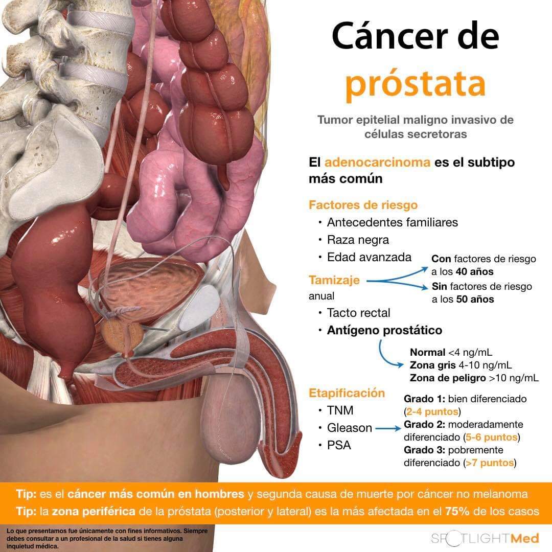 agrandamiento prostatico grado 3 agrandamiento prostatico grado 3