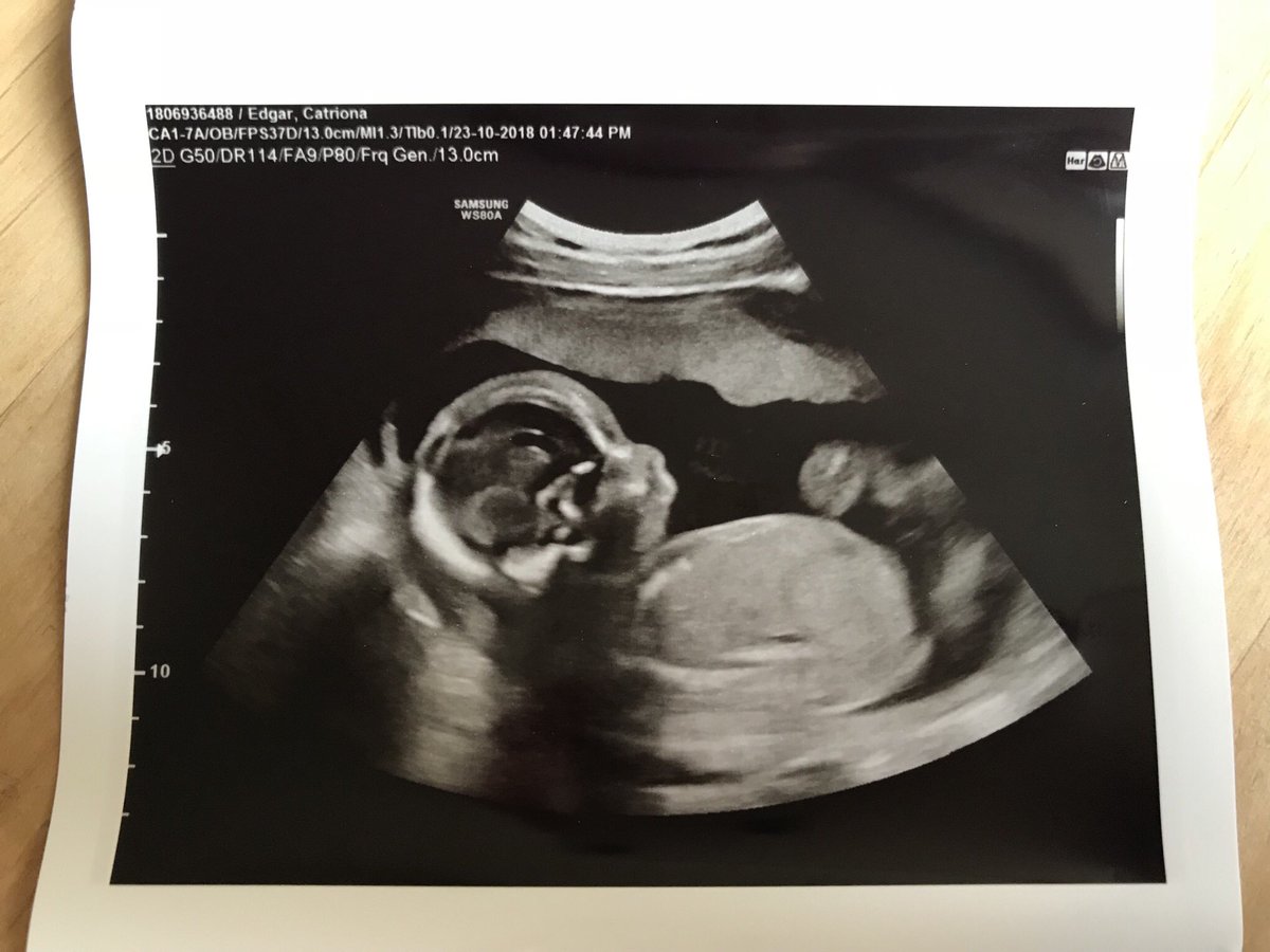 MusingsMaternal's tweet image. Our healthy, happy, wriggly little baby! #20weeks #pregnancy #20weekspregnant