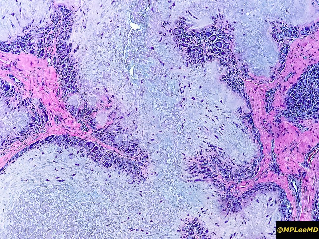 MPLEEMD's tweet photo. Gouty tophus. Accumulation of monosodium urate crystals which occurs in people with longstanding hyperuricemia.  Long, slender and needle shaped crystals. Granulatomous and giant cells surround this lesion.  #dermatology #dermpath #pathology #health #gout #science #histology https://t.co/eKdW826RYZ