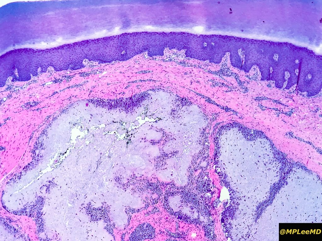 MPLEEMD's tweet photo. Gouty tophus. Accumulation of monosodium urate crystals which occurs in people with longstanding hyperuricemia.  Long, slender and needle shaped crystals. Granulatomous and giant cells surround this lesion.  #dermatology #dermpath #pathology #health #gout #science #histology https://t.co/eKdW826RYZ