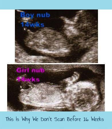 Window to the Womb on X: "Our Gender Scans Are 99.9% Accurate From 16 Weeks.  We Don't Scan Any Earlier Than 16 Weeks As the Accuracy Level Lessens ❤️💙  #genderscan #boyorgirl #girl #