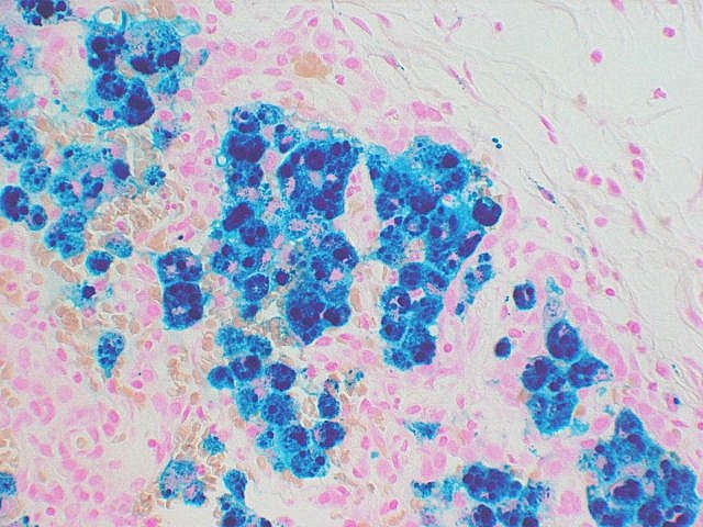 Pulmonary #capillaritis and #venulitis in an infant caused by #milkallergy
#pulmpath #vasculitis