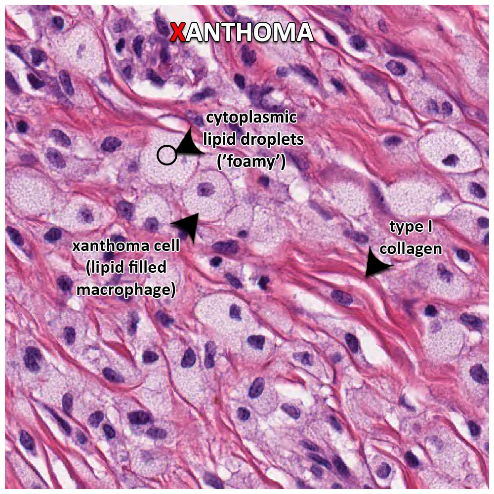 I Heart Histo on Twitter "X is for Xanthoma cells From the Greek