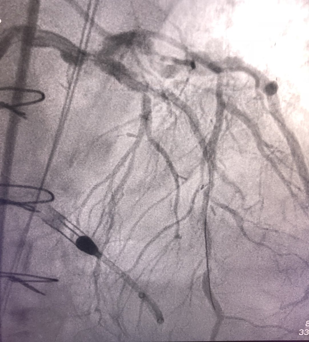 RajTayalMD's tweet image. “Doc I’m not done yet.” 83 yo CABG ‘99, COPD, AKI, anemia, EF 30%, mod-severe MR, CI 1.9 tx w Bipap &amp;amp; inotrope from OSH. AGREED! Impella CP 1.75mm #rotablator #Wolverine pre-dil #Synergy for #shortDAPT &amp;amp; @trytonmedical1 LM w #IVUS guided #POT @BSCCardiology. D/c &amp;lt;30hrs PCI!