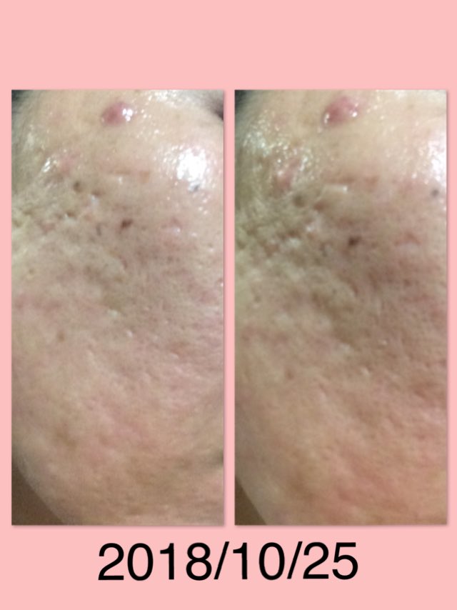 クレーター凸凹女 Twitterissa 剥けないハーブピーリング イオン導入 5日目の肌 なんか 肌荒れてる 当日よりもクレーターが目立ってるし 右頬のおっきあニキビも全然小さくならない