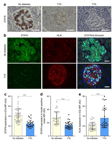 Diabetologia (@diabetologiajnl) on Twitter photo The STATistics of beta cell loss in type 1 diabetes: is STAT6 a player? #ExeterDiabetes #betacells #T1D; <a href="/afilesnice/">AFI LESLIE</a>; <a href="/ngmorgan1/">Noel G Morgan</a>; @Ibex01; <a href="/SarahIBEx/">Sarah Richardson</a> <a href="/DiabetesUK/">Diabetes UK</a> 🔓bit.ly/2NLRIsw #toptweet The STATistics of beta cell loss in type 1 diabetes: is STAT6 a player? #ExeterDiabetes #betacells #T1D; <a href="/afilesnice/">AFI LESLIE</a>; <a href="/ngmorgan1/">Noel G Morgan</a>; @Ibex01; <a href="/SarahIBEx/">Sarah Richardson</a> <a href="/DiabetesUK/">Diabetes UK</a> 🔓bit.ly/2NLRIsw #toptweet