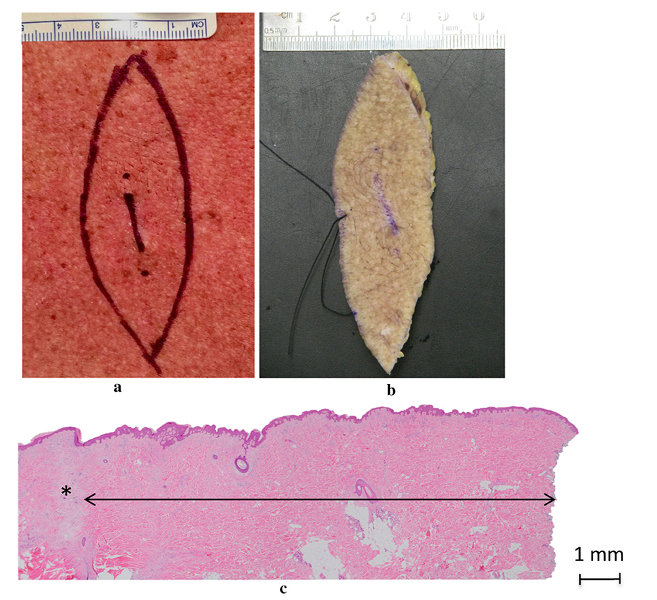 AnnSurgOncol's tweet photo. AHEAD OF PRINT: Correlation Between Surgical and Histologic Margins in #Melanoma Wide Excision Specimens. https://t.co/yoqr3EchzI @McMastersKelly @SocSurgOnc https://t.co/YXsfBsHTfm