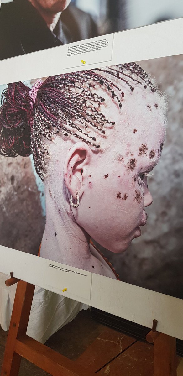 ACHPRreport's tweet photo. Photo installations depicting the lives of persons living with Albinism in Africa.
#ACHPR63 #ACHPRupdates https://t.co/r6iNYC12uY