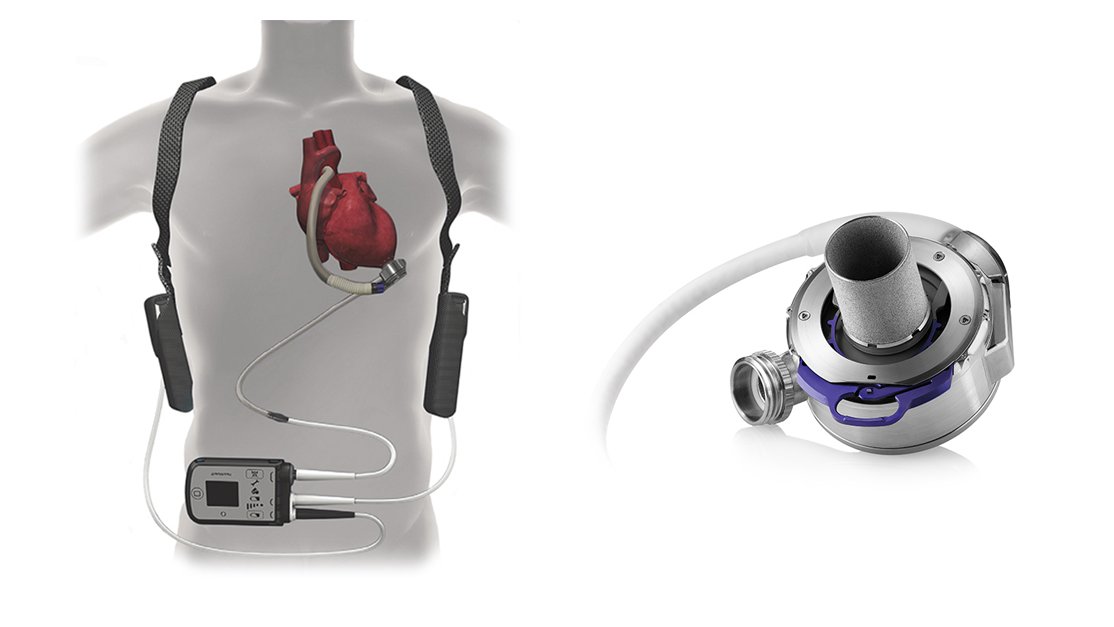CRT_meeting's tweet image. The newer #HeartMate3 #continuousflow #leftventricularassistdevice (#LVAD) improved on its predecessor in staving off #neurologicalcomplications among implanted patients, long-term results from the #MOMENTUM3 trial showed.
Read more: qoo.ly/sxujc