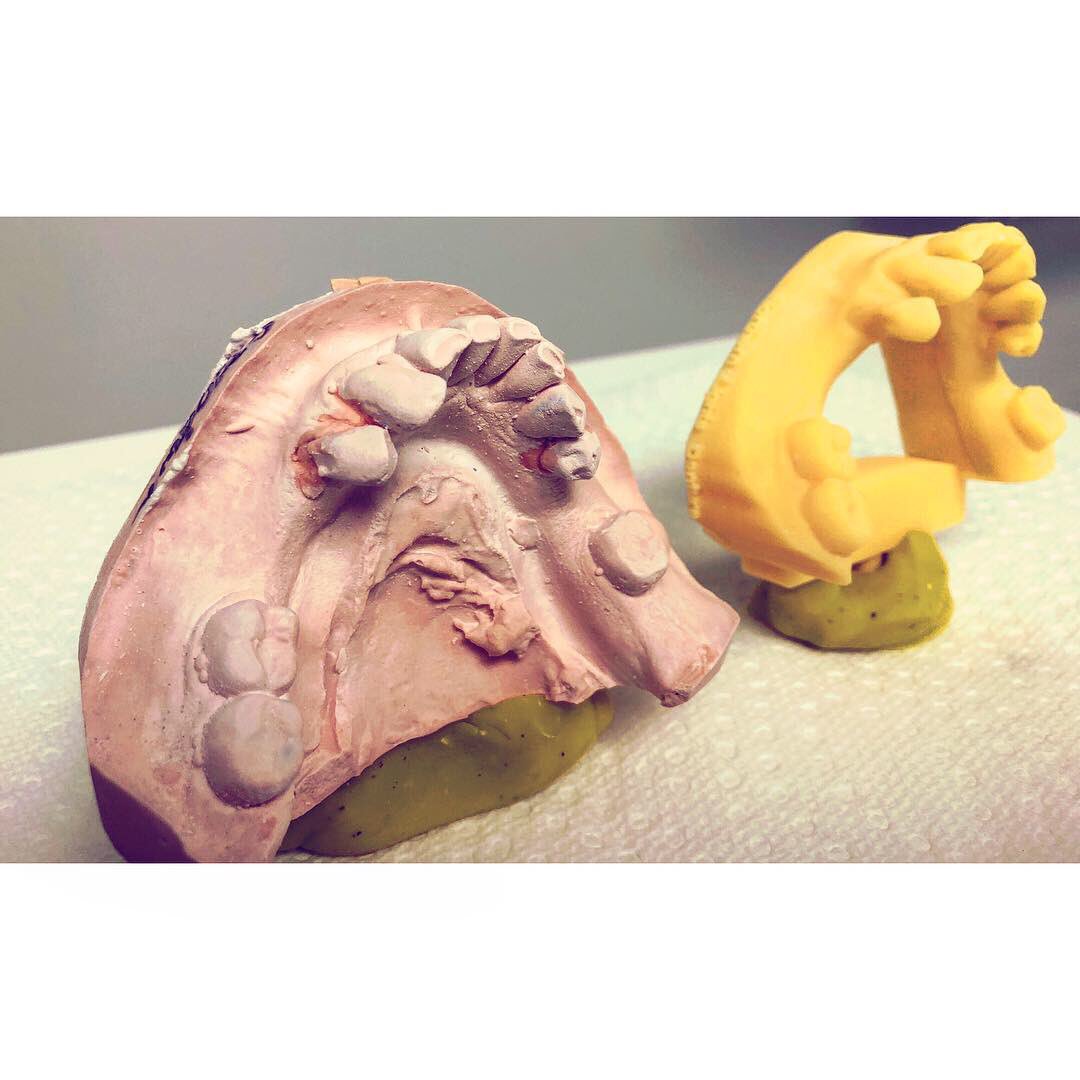 Stone model vs digital model #dentures #digital #model #dental #teeth