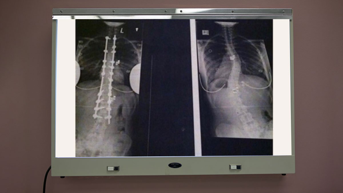 Have you faced adversity in #lawschool? Make sure to check out 2L student Alyssa Scarpulla's beautiful piece outlining her struggle with #scoliosis during her #1L year: bit.ly/2OKpLGL via <a href="/abalsd/">ABA for Law Students</a>