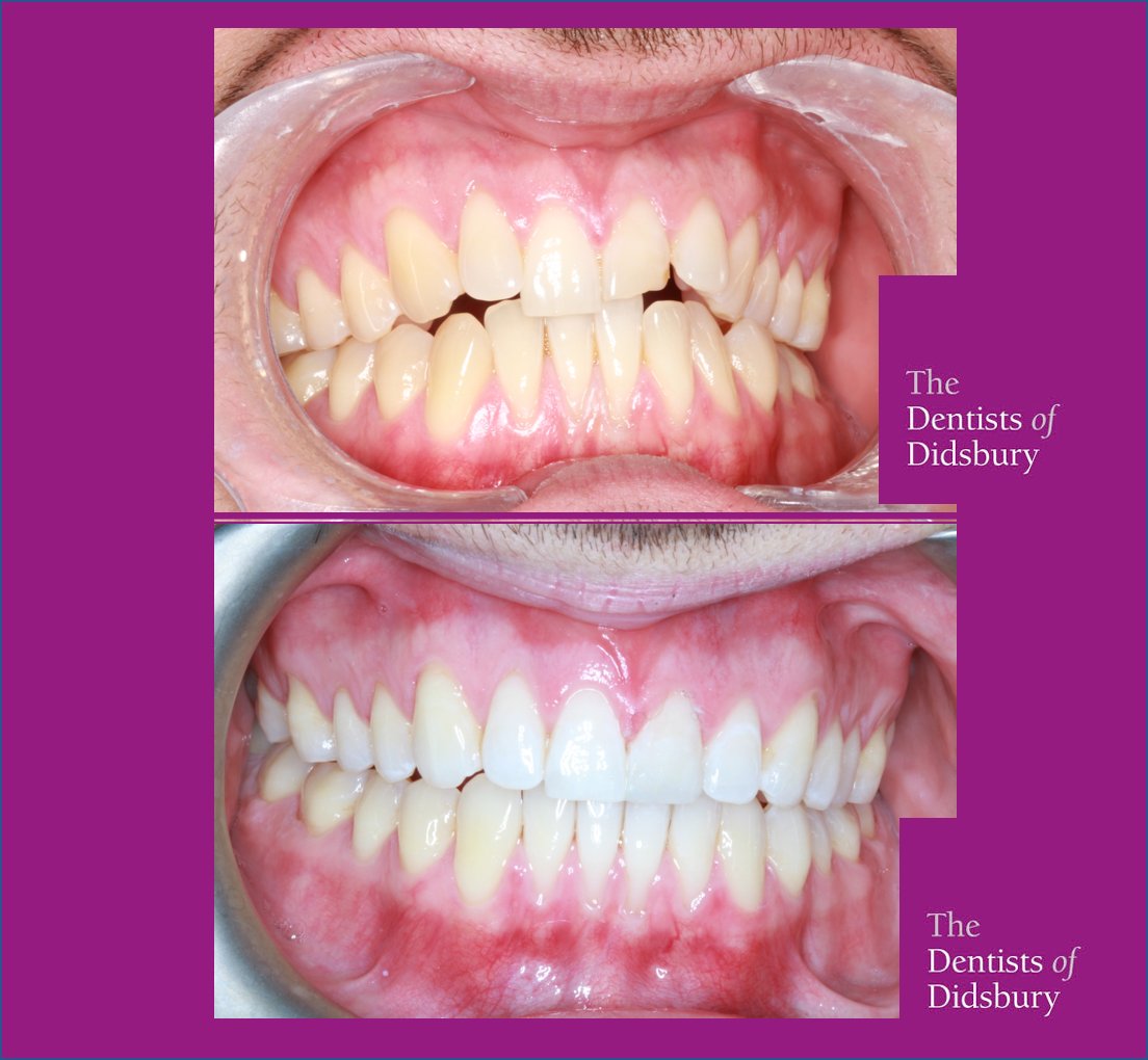 Total Smile Makeover!
Book in a for a consultation with us on 0161 445 4005
#TheDentistsofdidsbury #invisiblebraces #invisalign #invisalignsmile #invisalife #invisalignjourney #invisalignbeforeandafter #smile #newsmile #orthodontics #braces #braceface #progress #beforeandafter