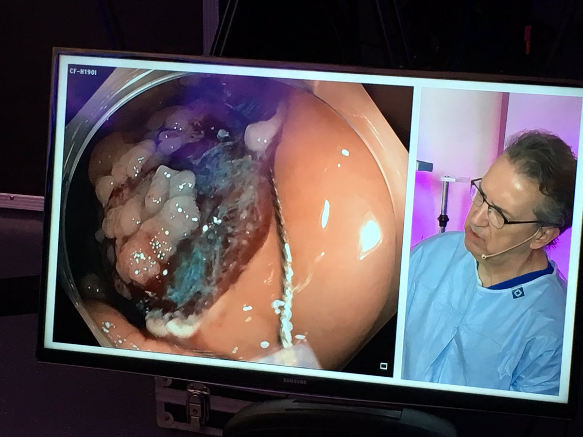 Great EMR teaching from Doug Rex  #EndoClubOnAir <a href="/BritSocGastro/">BSG</a>