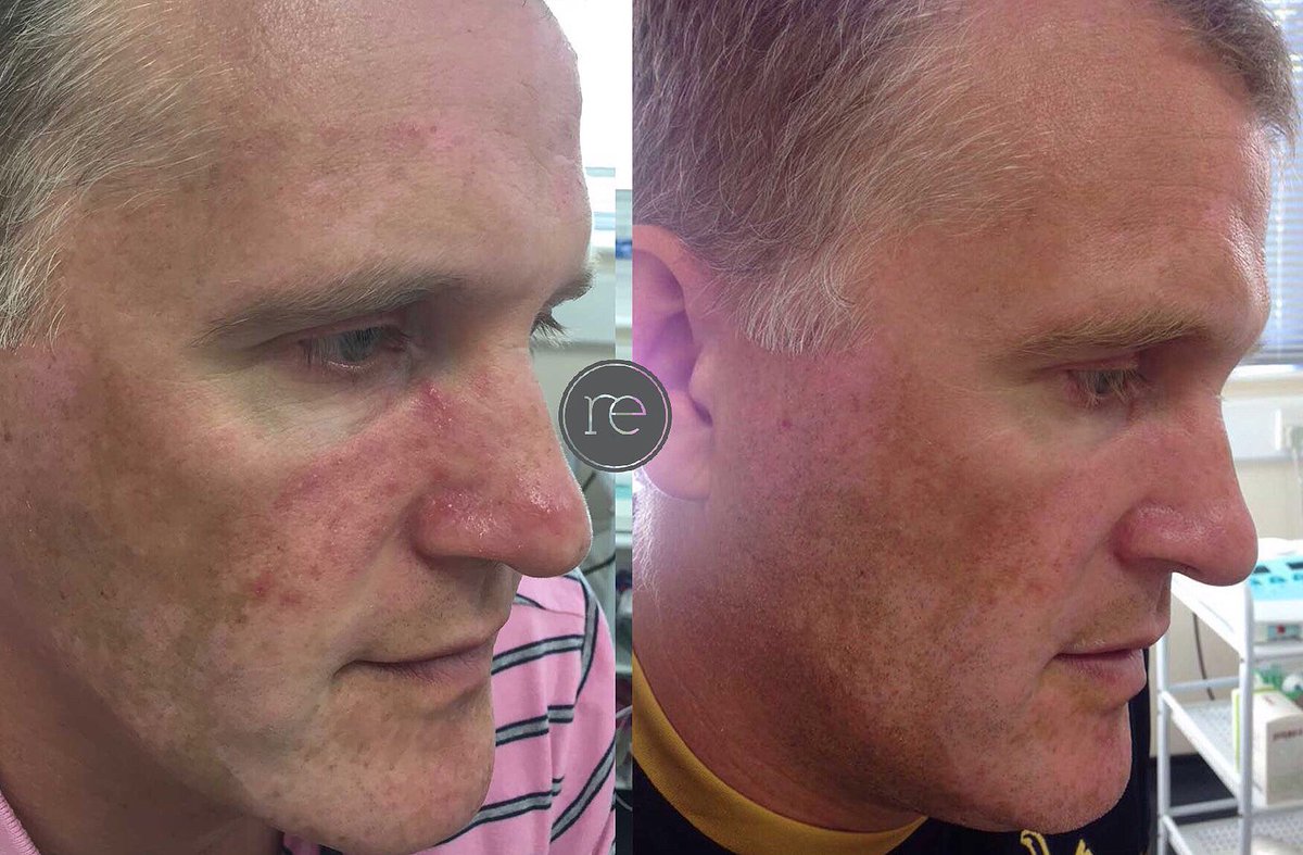 reenhance's tweet photo. Fed up of having uneven skin tone? Get your skin ready for the festive party season! Fantastic results from our patient using CLENZIderm M.D. System and having an Obagi Blue Peel.
-
#obagi #clenziderm #obagiproducts #facialproducts #products #rocasea #acne #unevenskin https://t.co/GJdfMWKgvX