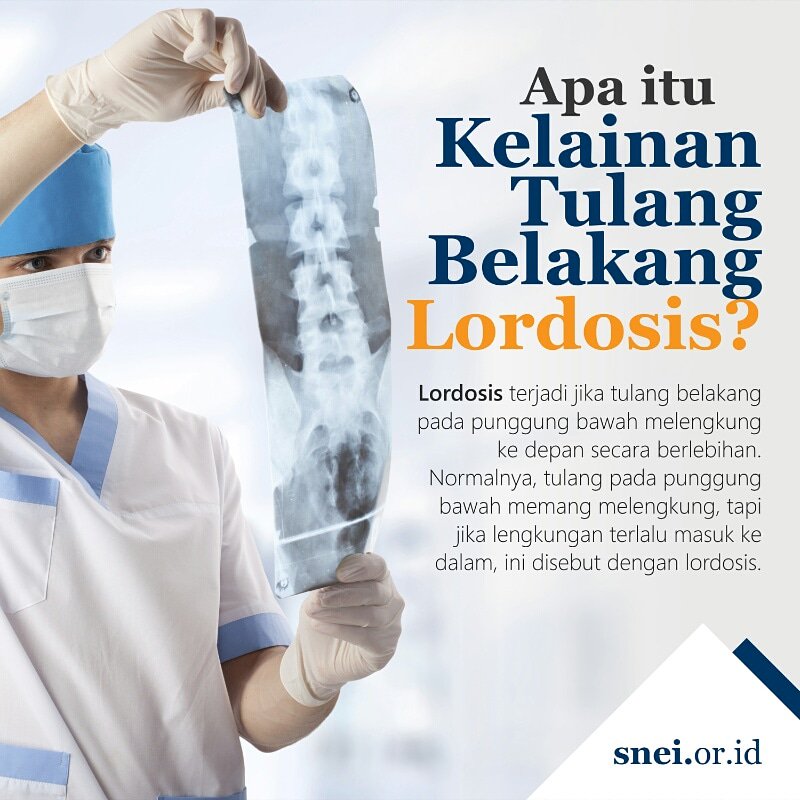 Apa Yang Dimaksud Dengan Lordosis