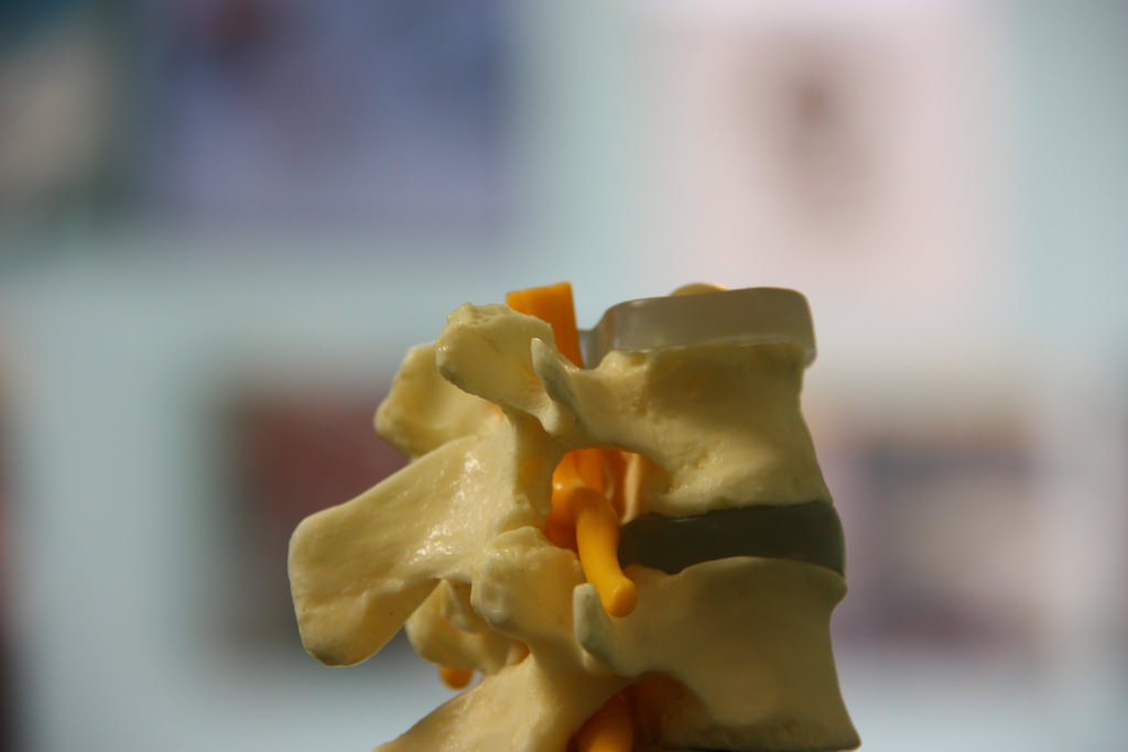 InsightImed's tweet photo. #Spinal #Brucellosis was a kind of #spineinfection that occurred in the #spinaljoint space or the surrounding #tissues of spine.The illness triggered #inflammation that present in #spinalintervertebral discs known as #BrucellarSpondylitis.For more vist https://t.co/k1VOFvLBjT https://t.co/POGLLAd5wZ