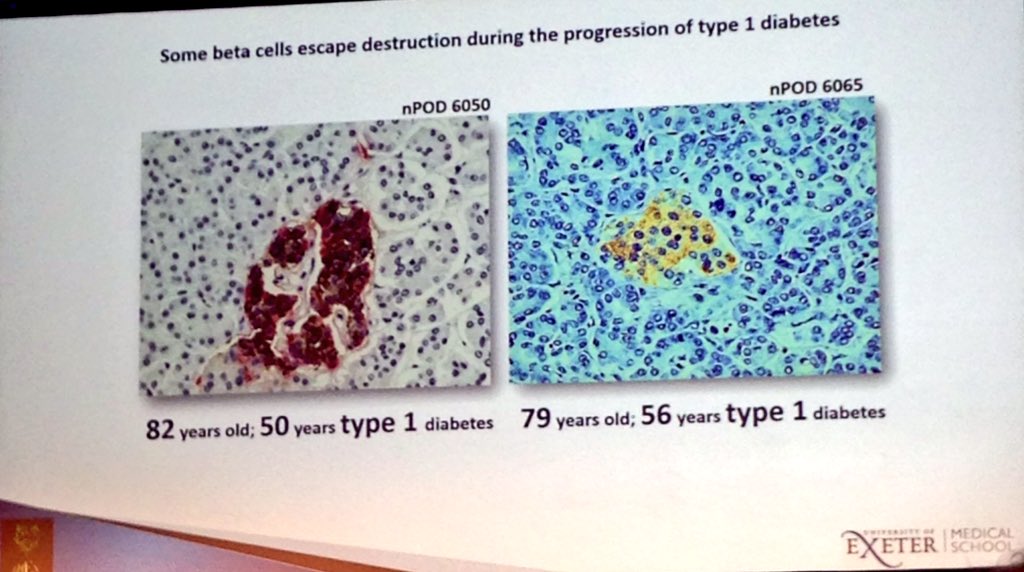ADDRESS_T1DRes's tweet photo. Amazing talk by @ngmorgan1 - so clear and very interesting. Understanding more about why come beta cells in the pancreas escape destruction during the process of #type1diabetes #IDS2018 https://t.co/mmIvtLck1T