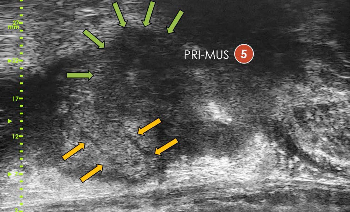 ExactImaging's tweet photo. NEW PAPER: Comparison of Accuracy of Micro-ultrasound and  MRI/US Fusion Targeted Biopsies for the  Diagnosis of CSPCa “..Micro-US  sensitivity for csPC detection was 94%... https://t.co/8GbpzITRbh #pcsm #exactimaging #EurUrolOncol #EuroWeb #prostatecancer #targetedprostatebiopsy https://t.co/lkmdzkaoVN
