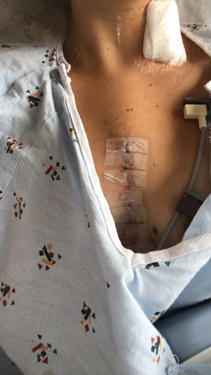 lyssbrads's tweet photo. 6 hours of surgery and one amazing heart surgeon later❤️❤️ my atrial septal defect and cleft mitral valve are all fixed and I can’t wait to be running marathons🏃🏽‍♀️❤️ https://t.co/g556nB6yQk