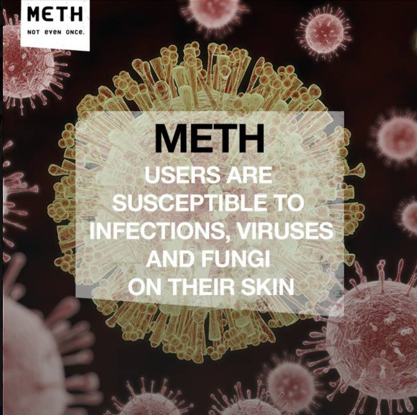 IDMethProject's tweet image. Methamphetamine suppresses killer T cell, white blood cells that fight off germs, viruses, and bacteria. Users are more susceptible to getting infections, viruses, and fungi, which may manifest as sore on the skin. #Notevenonce