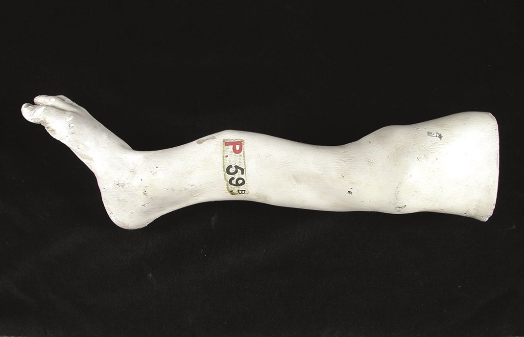 What can a cast of a child’s leg with rickets
tell us about gender equality in higher education? bit.ly/2yyURqO #UCLDisruptersAndInnovators
#HarrietteChick #KathleenLonsdale #Slade #UCLCulture #UCLArtMuseum
#WomenResearchers #WomenArtists