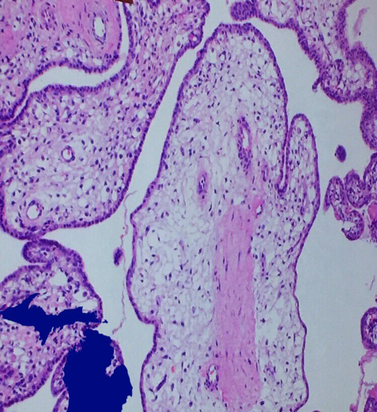 Welcome to MI! A very stimulating and interactive Perinatal slide session at the #SPPFallMeeting2018. Can you reliably differentiate villous edema from villous dysmaturity? ...me neither... 🤔😏#pedipath #perinatalpath #placentalpath