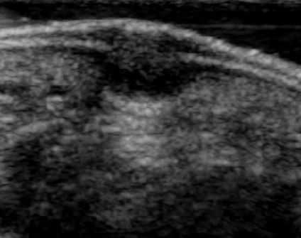 Jon A Jacobson Md On Twitter History Rule Out Foreign Body Note Characteristic Ultrasound Appearance Of Unsuspected Plantar Wart Epidermal And Dermal Involvement Increased Through Transmission And Dermal Arterial Flow Mskus Mskradiology