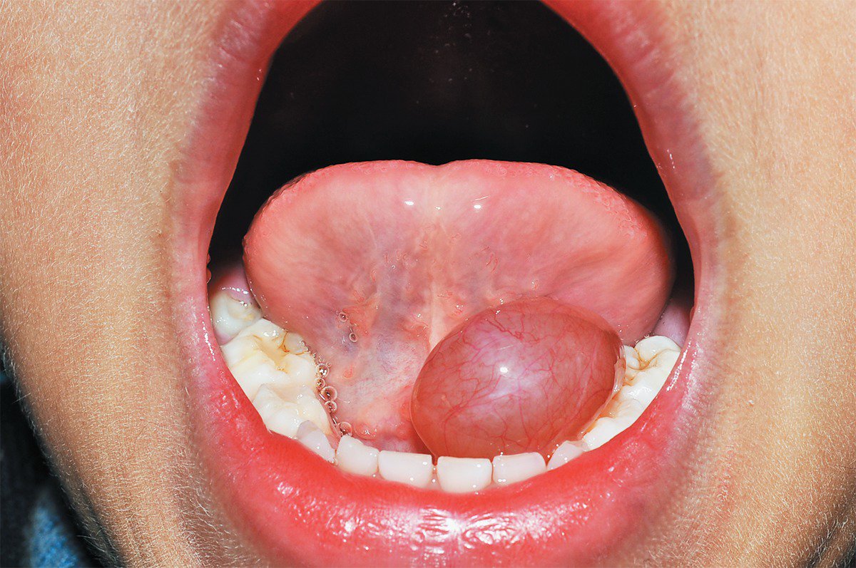 BedaiwiA's tweet photo. The ranula usually is located lateral to the midline, a feature that may help to distinguish it from a midline dermoid cyst,
They tend to be larger than mucoceles , often developing into large masses that fill the floor of the mouth and elevate the tongue.   #oralpath #made_easy https://t.co/fYrrQDswVq