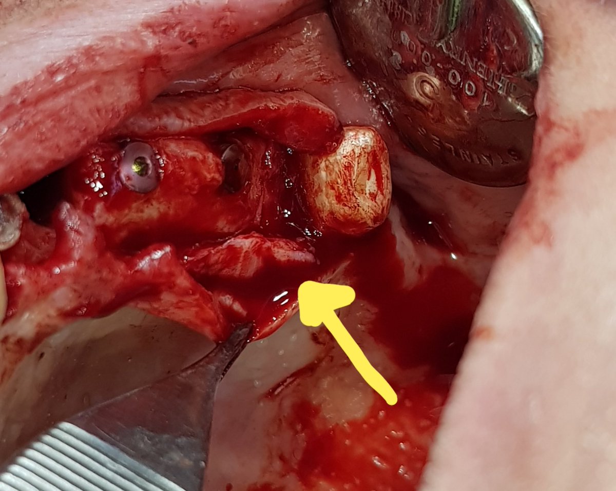 avendanodr's tweet photo. DFN 267. Alargamiento corona, extracción mínimamente traumática, nuevos implantes seven c/ bone compresor, tej. conectivo en bucal de tabla vestibular, xenoinjerto y dermis. #misimplants , #meet, #perioimplant, @avendanodr, @MisImplantsElsalvador https://t.co/TRWMFDQm9U