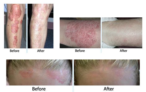 Mike Walker on Twitter: "Does UV Light Treatment Help – A Psoriasis Phototherapy Guide https://t.co/pAPT5G5uuo #psoriasis #PsoriasisTreatment https://t.co/rRbEeCIAAR" / Twitter