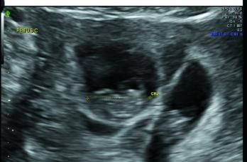 ContempOBGYN's tweet photo. Early imaging is key to the diagnosis of the many #anomalies that are unique to #multifetal gestations. The third #slideshow of our ultrasound collection includes examples of these anomalies. https://t.co/YDOLFXLMrb https://t.co/8NYcN9iDf4