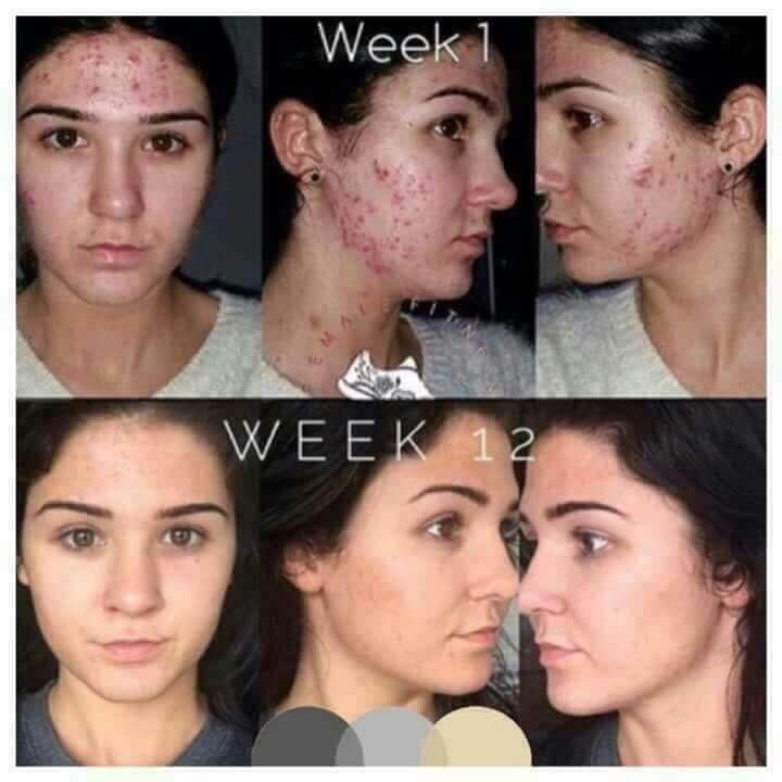 The power  of premium capsules 💪👍❤💋🍒🍏🍐🍑🍓🍆🍅
This is  what happened  when someone feeds  the body  with  the right  nutrition.

Inbox me let’s chat.
#thehealthylifestylecampaign #skin #skincare #skincaretips #skinfood #body #pimples #pimple #skinproblems #skinproduct