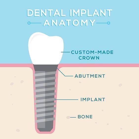 cfcdsfl's tweet photo. What are DENTAL IMPLANTS? They have the same basic shape as real teeth, They even look and feel like your real teeth and allow you to eat better and maintain your long term oral health!
.
.
#CFCD #DentistMiami #DentalImplants https://t.co/Out2Vqk21V https://t.co/gK4KZCZzNo