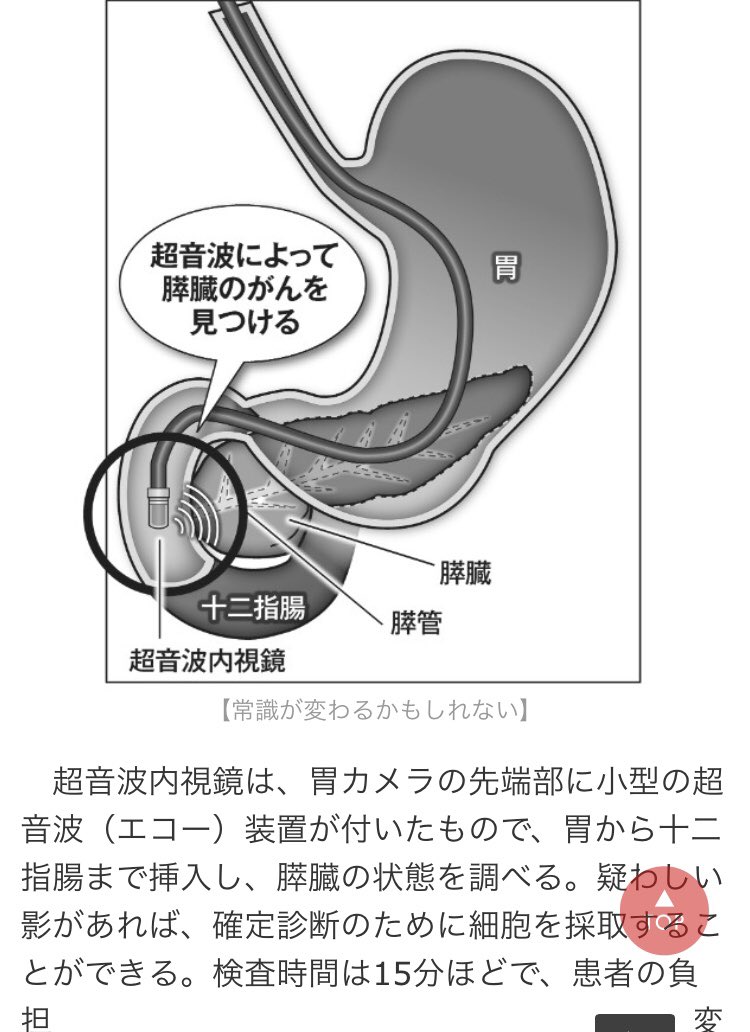 日本医美保健网 On Twitter 日本 加强胰腺癌体检 超音波内視鏡検査 胃カメラの先端部に小型の超音波 エコー 十二指腸まで挿入調べる 一个需要重视的现象 许多医院缺乏专业设备 缺少专业医生及不重视