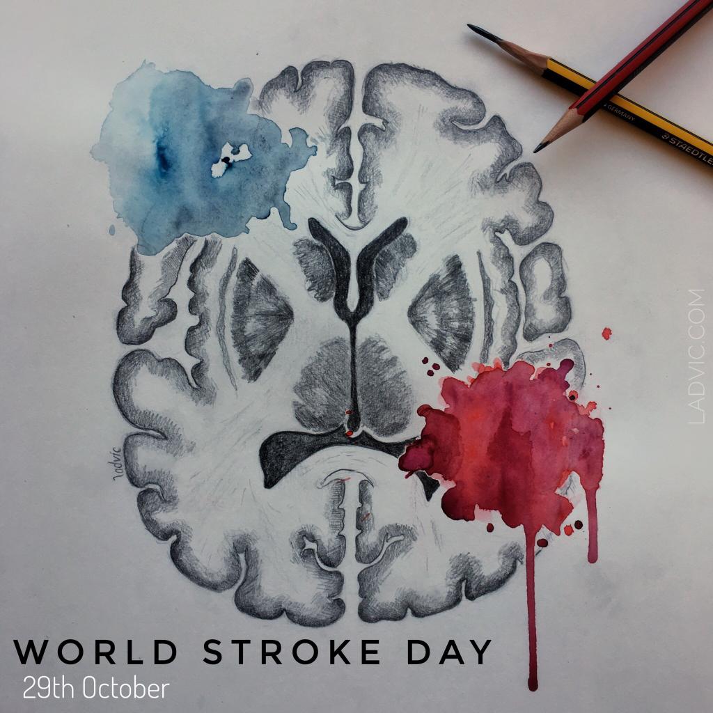 chukwudiagbor's tweet image. Do you know that Stroke is the second leading cause of death globally, resulting in 5 million deaths every year? 
Issa thread.
 #WorldStrokeDay #UpAgainAfterStroke 
@aproko_doctor @DrTedros @OgbeniDipo @DrETPeters @DrCharlse @AGuyWithASteth @KOsquared @DrJohnAfam @NaijaFlyingDr