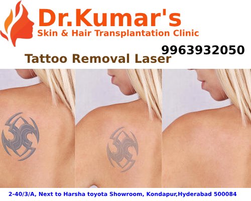 drashokkumar143's tweet image. Tattoo Removal Laser Treatment in Hyderabad
thehaircare.co.in

Best Tattoo Removal Laser Treatment is available our Clinic

#Tattoo_Removal
#Skin_care
#HairCare_Clinic
#Hair_Transplants
#Hair_Transplantation_in_Hyderabad
