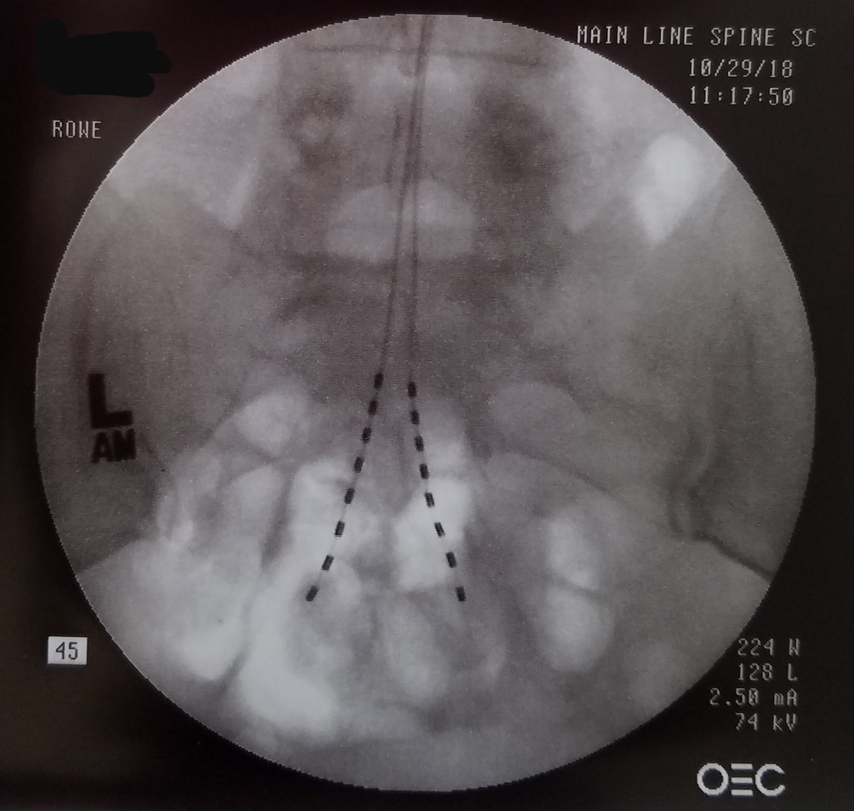 JefferyRoweMD's tweet photo. Pelvic Floor Dysfunction treated with retrograde leads placed to S3 and BurstDR programming provides a patient with nearly 100% reduction of pain (Lateral Neuro Pathway) and Suffering (Medial Neuro Pathway)!!
#pelvicpain #coccydynia #BurstDR #SpinalCordStim #SCS #ChronicPain https://t.co/x6SsBgMF2F