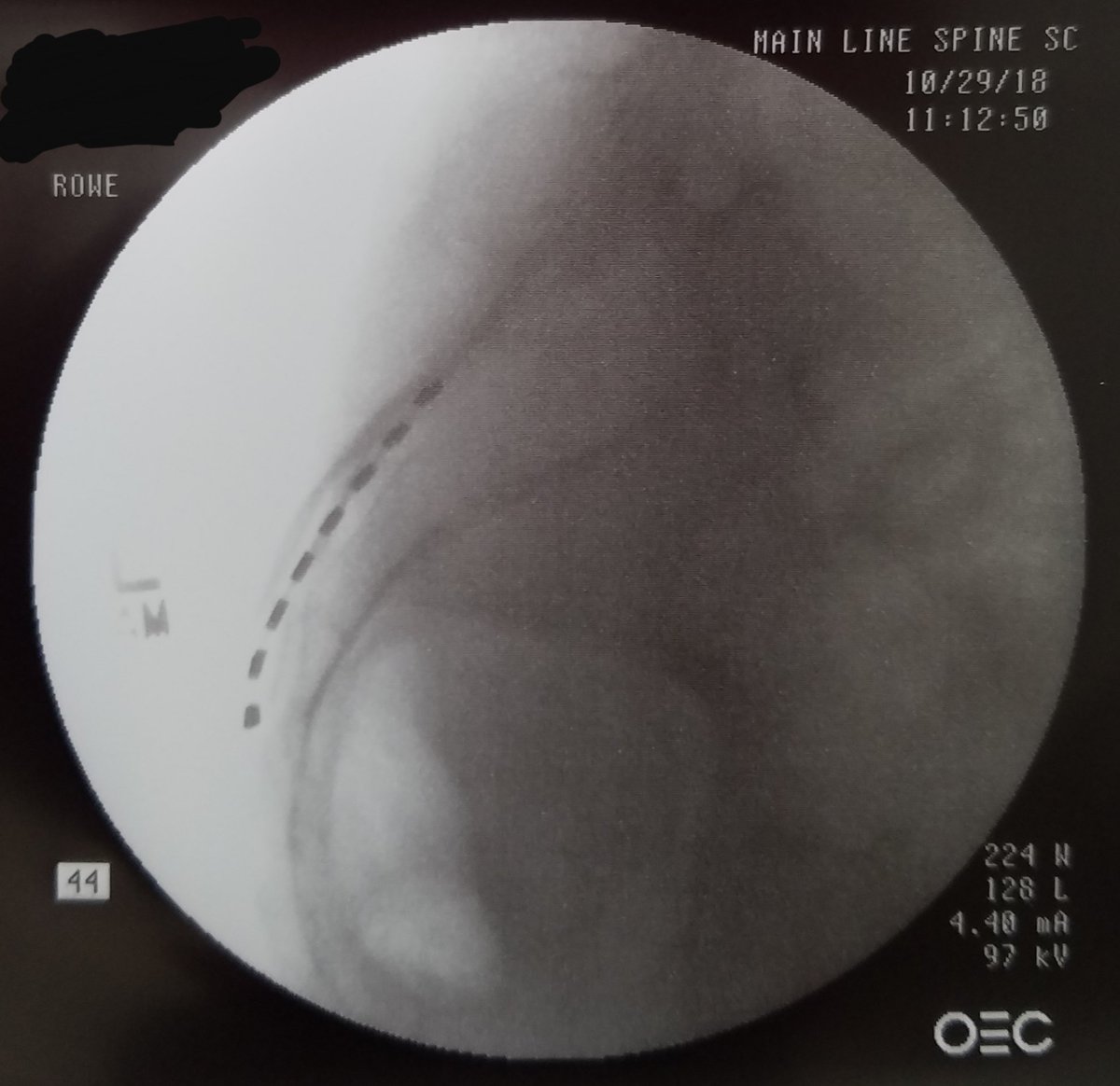 JefferyRoweMD's tweet photo. Pelvic Floor Dysfunction treated with retrograde leads placed to S3 and BurstDR programming provides a patient with nearly 100% reduction of pain (Lateral Neuro Pathway) and Suffering (Medial Neuro Pathway)!!
#pelvicpain #coccydynia #BurstDR #SpinalCordStim #SCS #ChronicPain https://t.co/x6SsBgMF2F