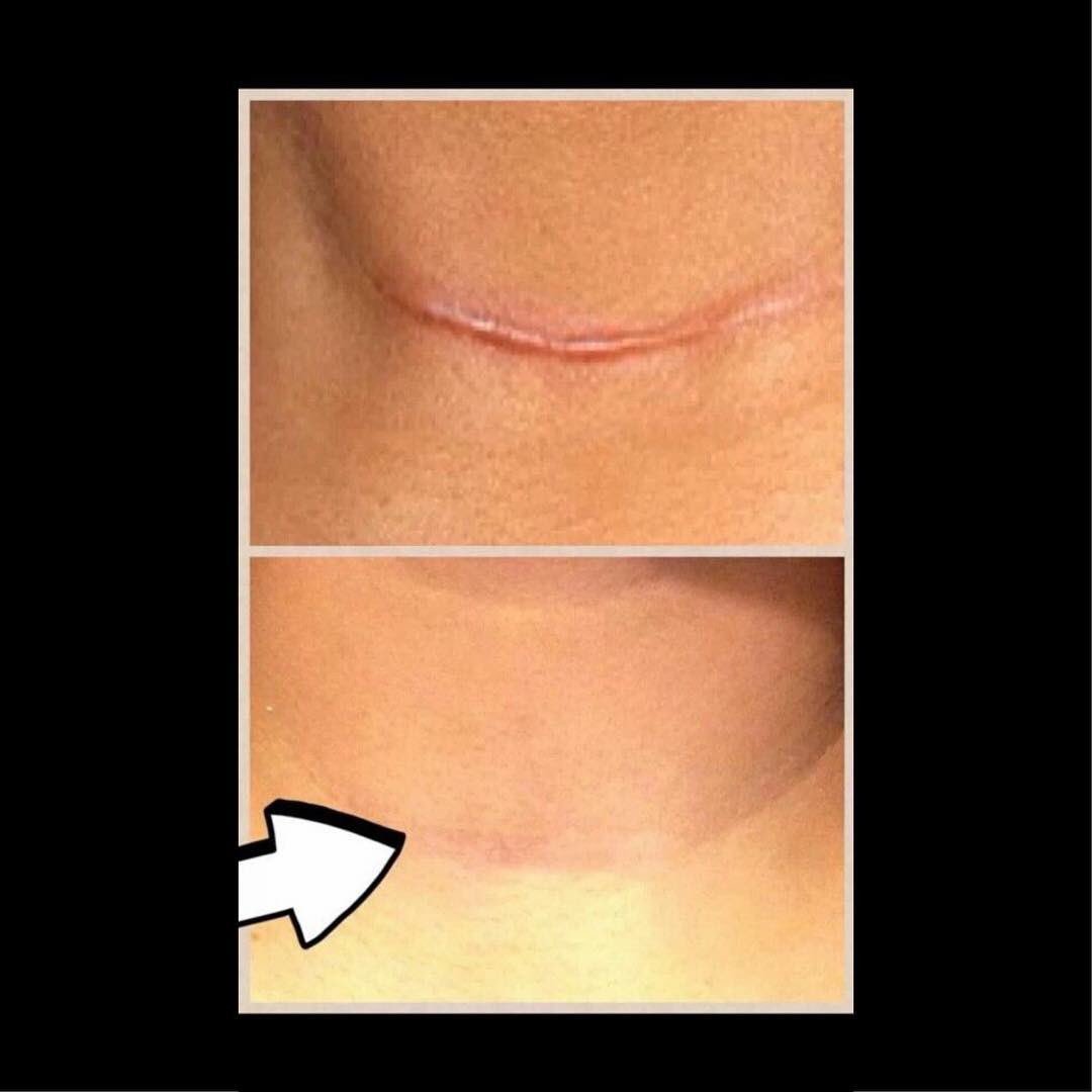 Kizzlerz's tweet photo. LIQUID GOLD! It helps sun burn. Eczema. Bug bites. Burns. EVERYTHING! &amp; the next 2 days buy 1 get 1 FREE! No monthly commitment, and even with daily use these two bottles will last MONTHS! Comment or message me for info! 🤗 #liquidgold  #sunburn #bugbites #eczema #bogo #tattoos https://t.co/ReSufcoiKd