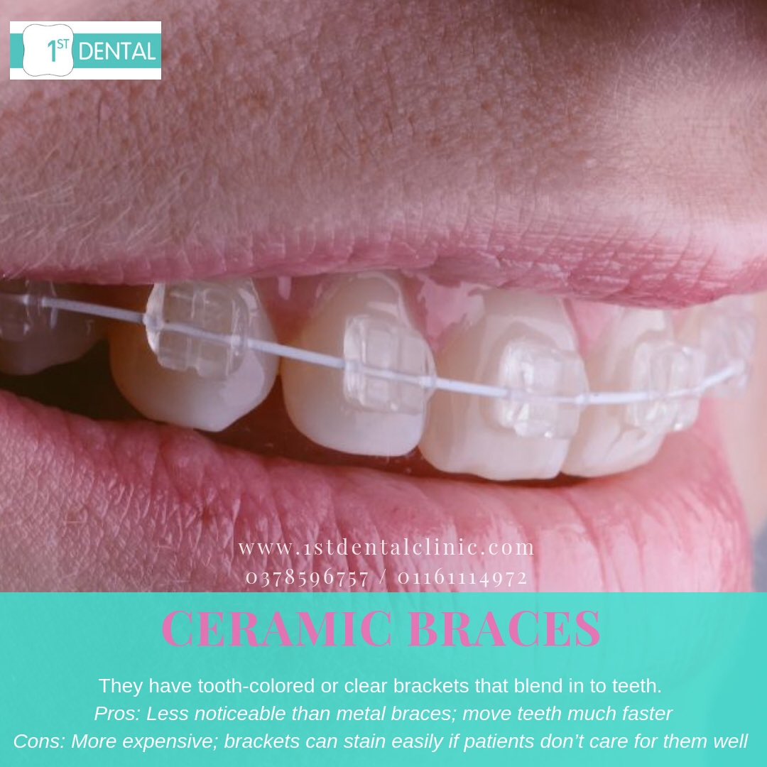 1stdentalclinic's tweet photo. 1st Dental Ceramic Braces Package :
๐Monthly Instalment : RM150
๐Deposit : RM3500
For enquiries & bookings :
๐0378596757
๐ฒhttps://t.co/J41hYf3ZRM
#1stdentalbukitjelutong #1stdentalyourbracessolution #klinikgigi #shahalam #promobraces #bracesshahalam #dentistnearme https://t.co/1YtKuFCXLn