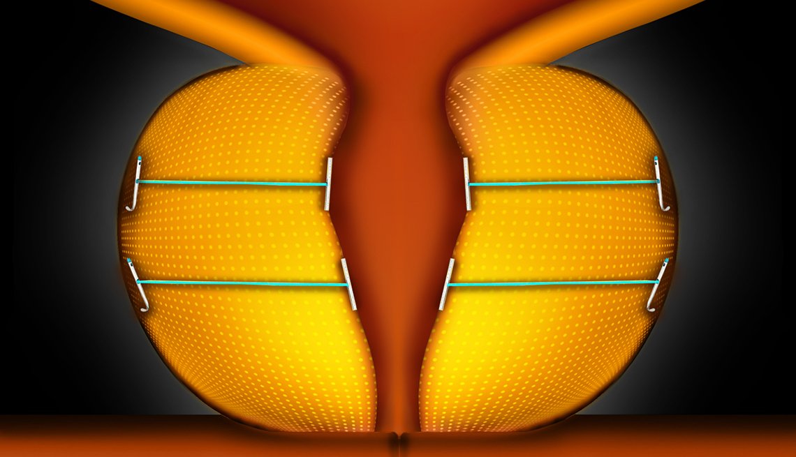 UroLift's tweet photo. If left untreated, #BPH can lead to permanent bladder damage.  The @UroLift System was featured in @usnews in their 10 Tips for Promoting a Healthy Bladder. https://t.co/W6xywaFznj https://t.co/ZfdmLPt7Sm
