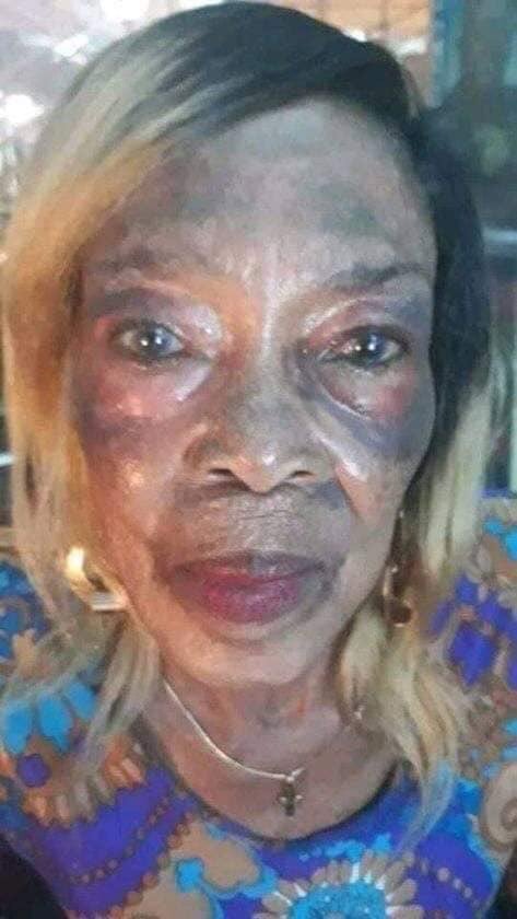 ThembaRumbu's tweet photo. Can we please make this Viral because these skin bleaching products are messing up Black peoples skin https://t.co/yC7wwVm7UG