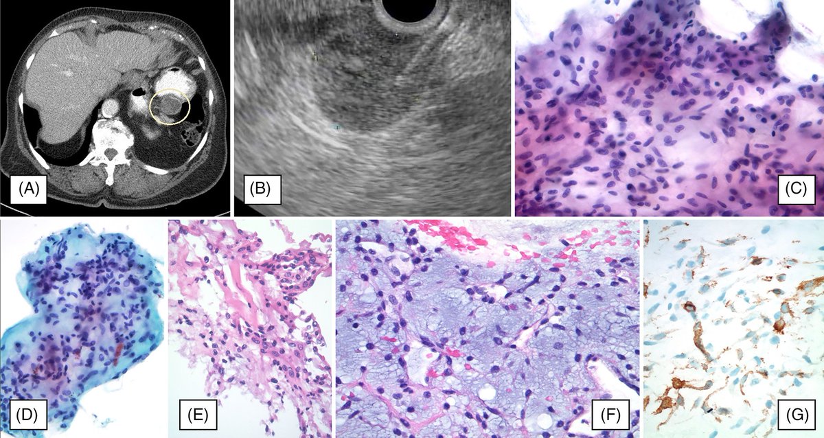 DiagnosticCyto's tweet image. Dr. Rohit, @GIlymphomapath @ClevelandClinic review EUS-FNA of GI spindle cell neoplasms including a novel case of gastric plexiform fibromyxoma: ow.ly/L7Jr30mmp35 #GIPath #FNApath