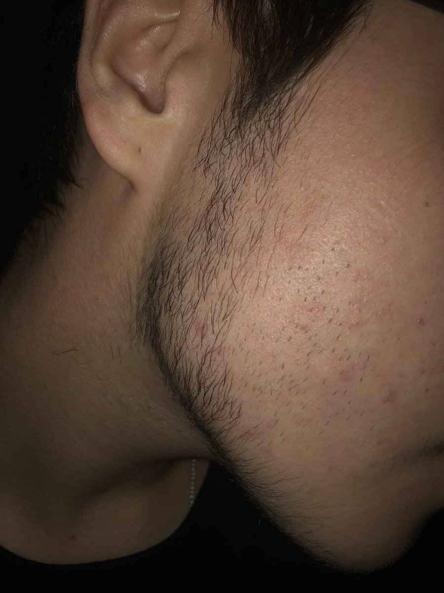 facial hair update! (one day, i should really make a thread of my updates to see the progress it’s making lol)i have?? so much hair under my chin?? patience is key when taking T if you want facial hair and i’m really happy with what i’m starting to have so far!!