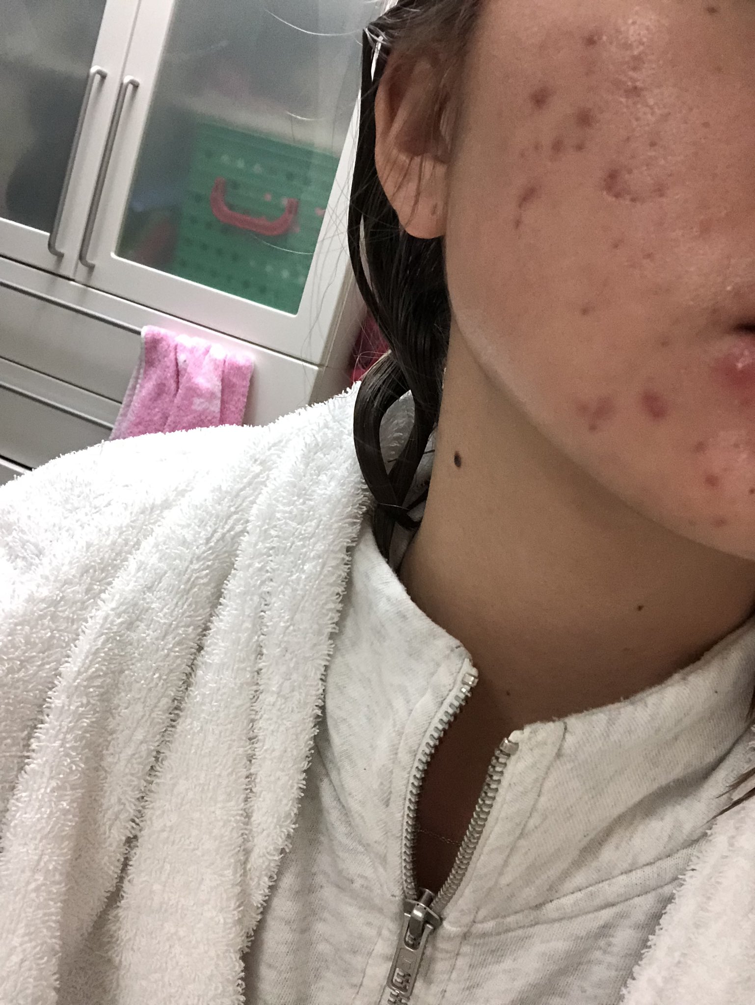 Maadookaa 半年くらいまで汚肌だったけどヤーズ飲み始めて3ヶ月ちょいでここまで綺麗に ニキビ跡は残ってるけどwニキビで悩んだら皮膚科じゃなくて婦人科をおすすめします すっぴんのno加工 ヤーズ 肌荒れ改善 ニキビ ニキビ治療 Maadookaa 半年くらいまで汚肌だったけどヤーズ飲み始めて3ヶ月ちょいでここまで綺麗に ニキビ跡は残ってるけどwニキビで悩んだら皮膚科じゃなくて婦人科をおすすめします すっぴんのno加工 ヤーズ 肌荒れ改善 ニキビ ニキビ治療