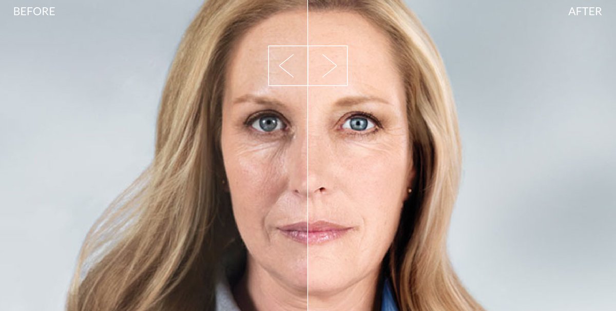 DallasSkin's tweet image. Do you have facial volume loss you would like to rejuvenate? If so, you may be a great candidate for #SculptraAesthetic, a volumizing #filler that lasts up to two years! #VolumeLoss #Wrinkles #AntiAging #SkinExperts