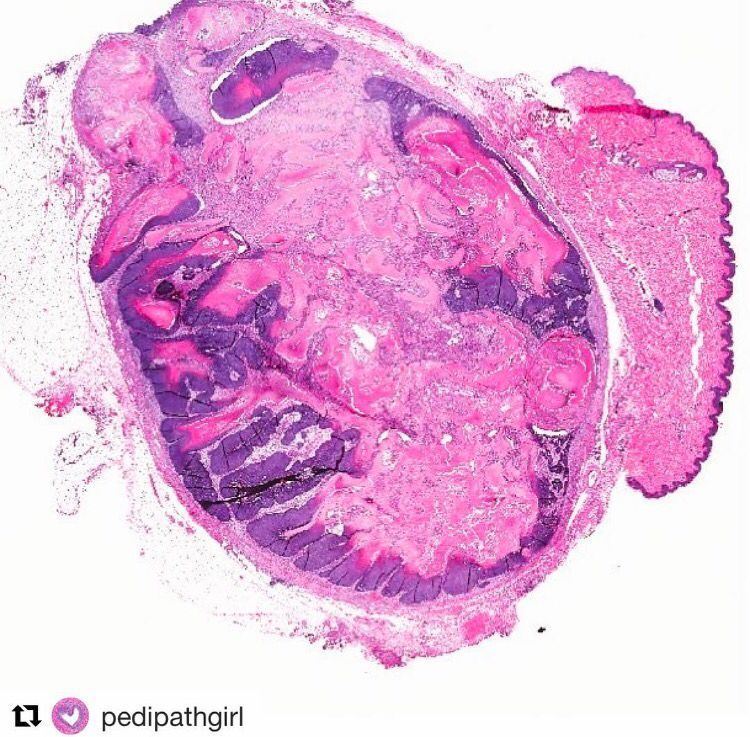 JMGardnerMD's tweet image. Pilomatricoma. Round blue matrical cells &amp;amp; pink ghost cells (these give a chalky chunky gross appearance) #Pathology #dermpath #dermatology
