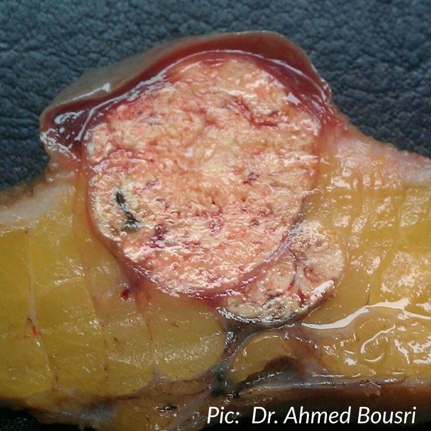 JMGardnerMD's tweet image. Pilomatricoma. Round blue matrical cells &amp;amp; pink ghost cells (these give a chalky chunky gross appearance) #Pathology #dermpath #dermatology