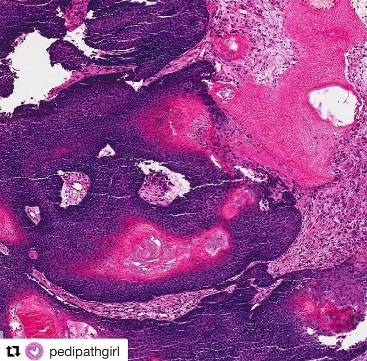 JMGardnerMD's tweet image. Pilomatricoma. Round blue matrical cells &amp;amp; pink ghost cells (these give a chalky chunky gross appearance) #Pathology #dermpath #dermatology