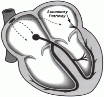 HartKliniek cardioloog Mai Ngo bespreekt in deze nieuwsbrief het Wolff-Parkinson-White syndroom (WPW), een aangeboren hartritmestoornis. Lees de brief op tinyurl.com/hartkliniek-wpw  #hartkliniek #WolffParkinsonWhite #cardiologie #maingo